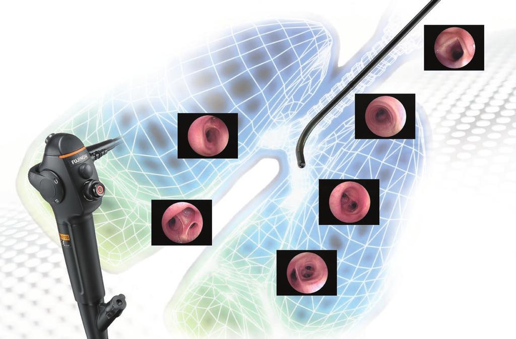 Fujinon has been an industry leader in endoscopes for more than 30 years and pioneered many of today s technologies in gastrointestinal endoscopy.