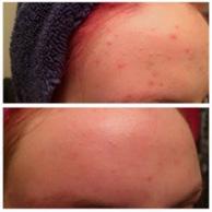 Pre-Party Post # 6: Blemished/Acne Prone Skin Testimonial: This is my daughter Kara. She has been using L BRI oil blemished trio + KlearAway and the Clay Masque!! It does wonders, she says!
