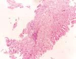 The biopsates taken are large and therefore provide sufficient tissue for diagnostically