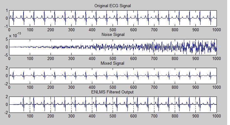 Hence, all these algorithms prove effective in the removal of PLI from ECG signal. Thus, the morphology of the signal is maintained and effective diagnosis of the patient can be achieved.