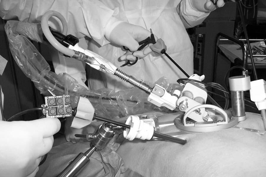 Fig. 6. Endoscope robot in surgery Fig. 7. Modular robotic surgery system miniature keypad attached to one of the surgical instruments.