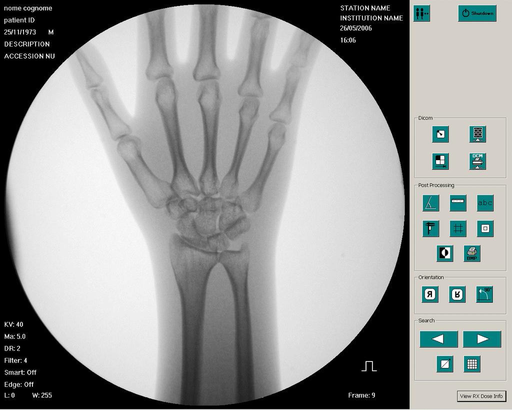 Imaging LCD display ms-x-ray pulsed fluoroscopy, image sharpness High contrast low noise image with high ma/pulse ratio