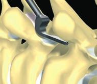 S U R G I C A L T E C H N I Q U E insertion of vertebral anchors Claw Fixation 2 The claw consists of two hooks facing each other, one main polyaxial hook and one counterhook which closes the claw.