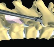 THORACIC FIXATION USING A PEDICULO/TRANSVERSE CLAW: Combination of a polyaxial pedicle hook for claw available in 2 sizes: 4 mm (MS 421-0 ) or 6 mm (MS 421-1) and a transverse counterhook: MS 420-2S