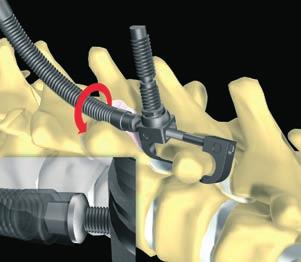 Initial closing of the claw using the Compressor forceps for claw (MS