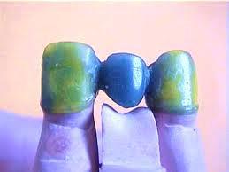 cobalt/chromium partial denture.