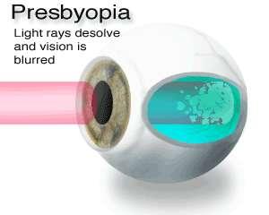 Eye Defects Presbyopia Old Eyes Eyes lose ability to flatten and bulge
