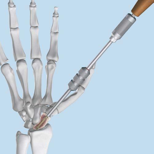 Scaphoid Fixation 7 Insert screw head Instruments 03.226.000 Compression Sleeve for 3.0 mm Headless 03.226.004 Cannulated StarDrive Screwdriver Shaft, T8, quick coupling Hold 03.
