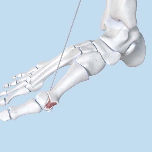 First Metatarsal Osteotomy 3 Insert guide wire Instruments 292.622, 1.1 mm Guide Wire (threaded or nonthreaded) 292.