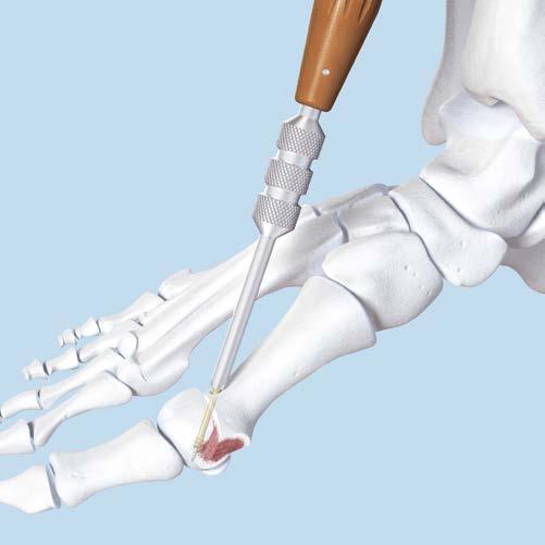 First Metatarsal Osteotomy 7 Insert screw and compress Instruments 03.226.000 Compression Sleeve for 3.0 mm Headless 03.226.006 Compression Sleeve Handle 03.226.016 Compression Sleeve for 2.