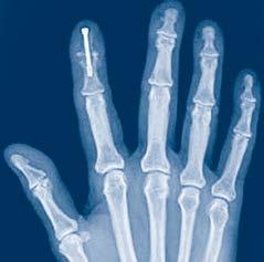 and nonunions of small bones and small bone arthrodeses,