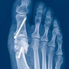 intra-articular and extra-articular fractures and
