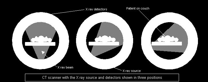 An X-ray source (and array of detectors) rotate around a patient taking multiple