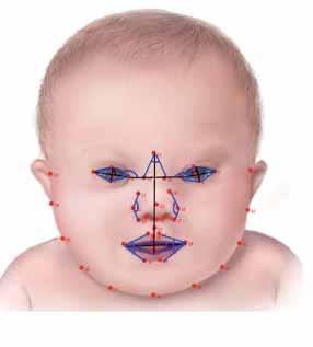 Down Syndrome Detection through Facial Images Ahmed Safa Salahat, Naoufel Werghi KUSTAR, Sharjah, UAE Down syndrome is a genetic disorder that occurs when a child is born with an extra 21th