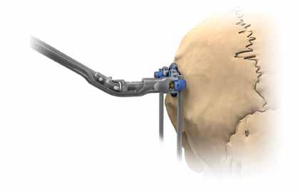 Engage the occipital tulip with the Angled Occipital Counter-Torque Driver, and rotate the Final Tightening Torque Limiting Handle to deliver the