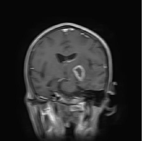 118 Ashraf A. Abdallah et al.: MRI Phase Mismapping Image Artifact Correction 3.