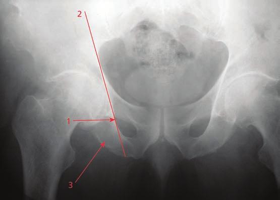 Key Bone Stock and Landmark Considerations Radiographic landmarks are helpful in assessing the acetabular bone stock.
