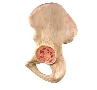 Possible Surgical Solutions by Defect Classification The Paprosky Classification is the most widely used acetabular