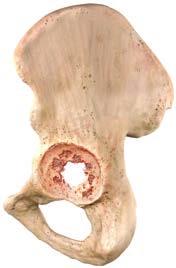5 Type 1 Anterior/posterior columns are intact and supportive Greater than 70 percent of host bone to hemispherical
