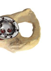 Free Hand Technique Once the acetabular cavity has been prepared, a hand held burr or acetabular reamer corresponding to the trialled cup size can be utilised to prepare and shape the remaining