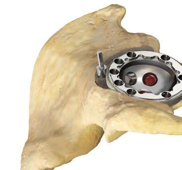 Implant Insertion Acetabular Shell-First Technique, continued Screw fixation of the Augment is performed using 5.