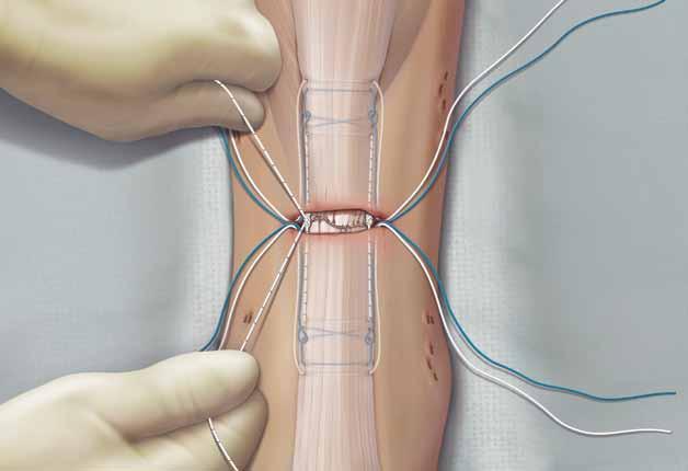 19 With the foot in maximum plantarflexion, tie the white/black suture on both sides of the