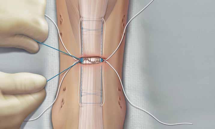 0 With the foot in maximum plantarflexion, tie the locked blue suture on both sides of