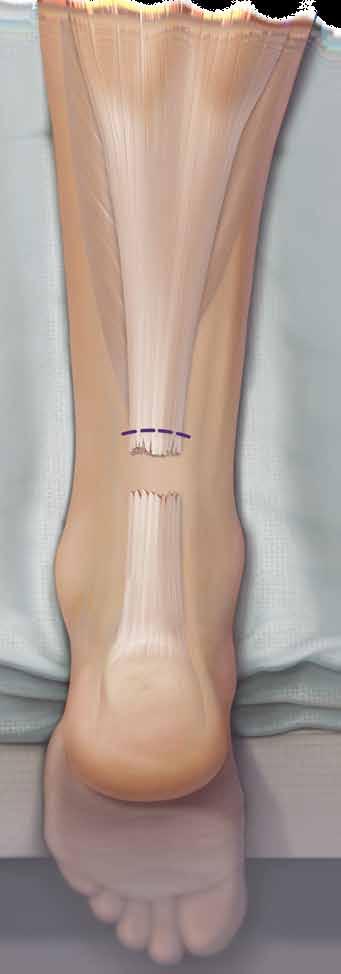 The PARS provides the opportunity for consistently reliable capture of the proximal and distal aspects of the Achilles tendon and utilizes color-coded FiberWire suture.