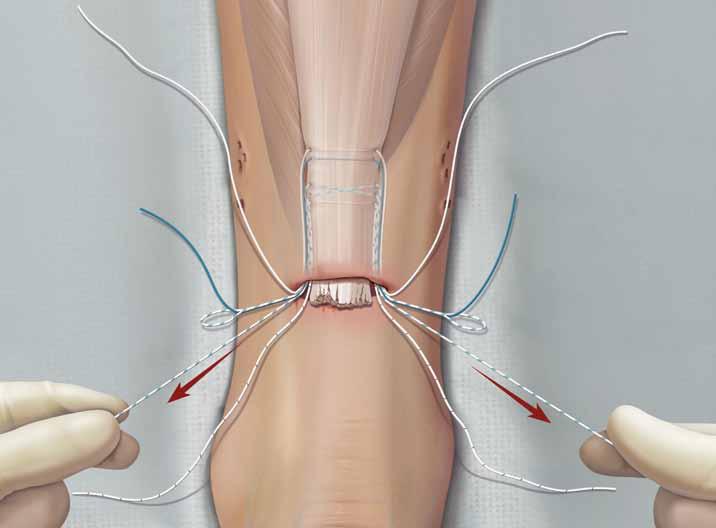 4 3 3 4 15 Pull the # suture through the Achilles tendon to the other side by pulling on the nonlooped side of the white/green