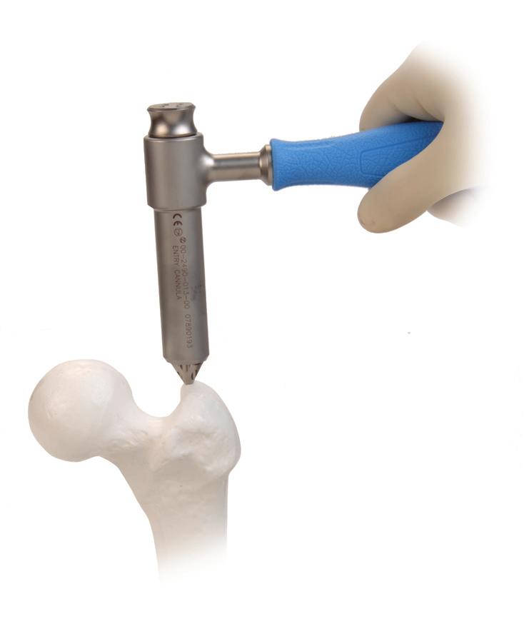 The use of a fracture table can be beneficial in helping to reduce fractures as well as to facilitate intraoperative imaging with a C-arm.