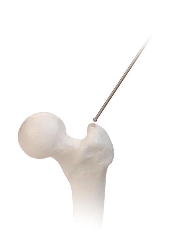Care should be taken not to drive the wire through the knee joint. A REDUCTION FINGER is included in the set. The ball tip guide wire can be fed retrograde through the REDUCTION FINGER.