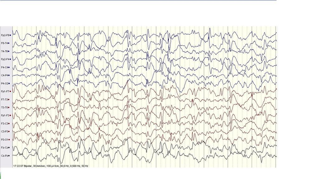 Figura 1. Activitate epileptiformă continuă, difuză, de tip Benign Epileptiform Discharge of Childhood Figura 2.