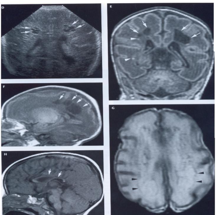 Tabloul imagistic prin tomografie computerizată aială se observă o hipodensitate corticală și subcorticală în regiunile parasagitale.