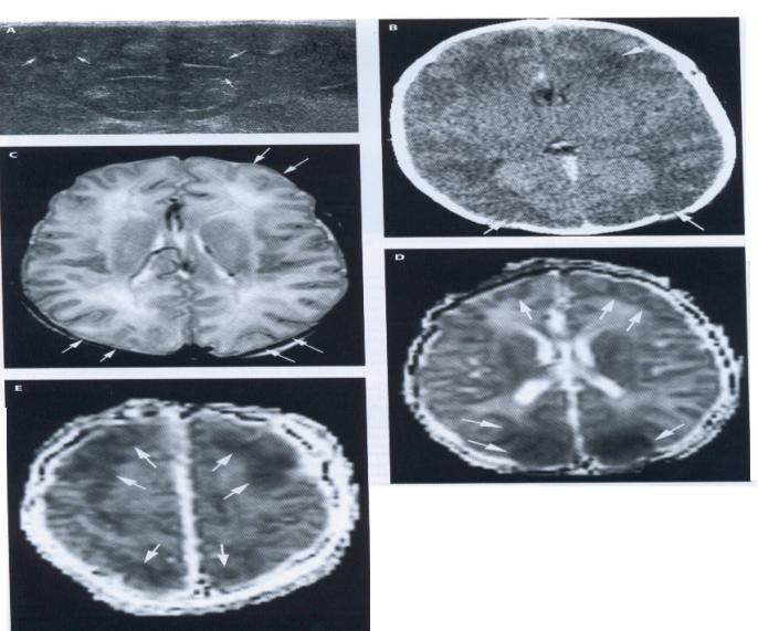 Figura 3. Neurosonografia, tomografia computerizată și rezonanța magnetică nucleară la doua zile copilul născut la termen (caz clinic 3).