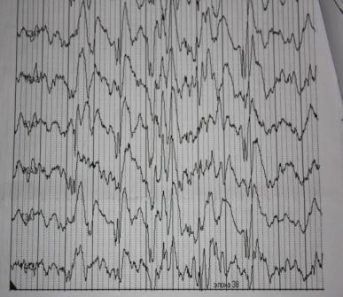4. Impulsație epileptoidă în formă de valuri ascuțite și compleuri de val ascuțit unda lentă cu iradiere în emisfera opusă din regiunea Ta-Tm pe dreapta cu etindere în reg F.