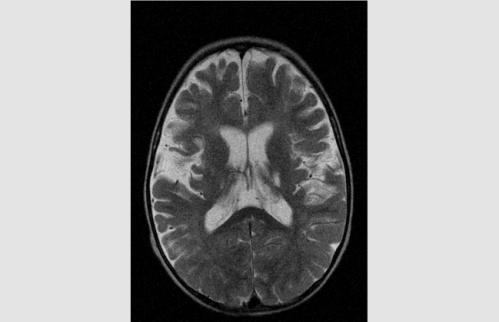 În toate cazurile CT cerebral a pus în evidență focare de hipodensitate, apoi de necroză în lobul frontal, temporal sau occipital al encefalului.