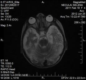 Eamenul prin RMN cerebrală a pus în evidență modificări sugestive pentru hipodemielinizare a substanței albe cerebrale pe fondal de infecție herpetică. Concluzii 1.