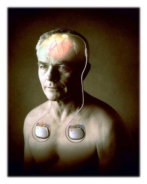 NEUROSTIMULATION Current treatment Electrodes implanted in the brain - Suppress undesired activity - Generate
