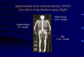 Science (ctnd) Assessment of Bone Loss in the Axial Skeleton in Long-Term Space flight Renal Stone Risk