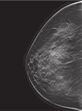 Mammo Tomo Digital mammography hardly revealed a parenchimal distorsion not clearly identified with the magnification.