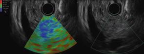 CHI Mode -H- ELASTOGRAPHY* Relative stiﬀness of the tissue is visualized as a color distribution map by calculating the distortion of