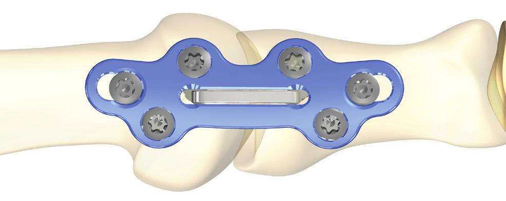 Superelastic Nitinol Compression Staple The Omni MTP Plate was designed to provide clearance for up to