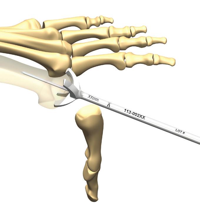 INDICATIONS FOR USE The Omni Foot Plating System is intended for use in internal fixation, reconstruction, or arthrodesis of the 1st Metatarsalphalangeal joint.