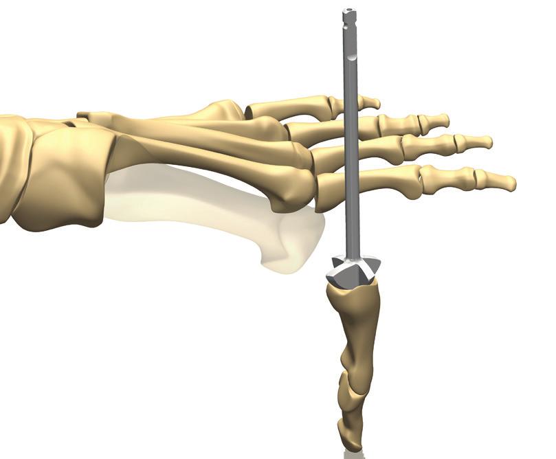 Joint Exposure Exposure the MTP joint by creating a dorsal longitudinal incision beginning just proximal to the interphalangeal joint, extending over the extensor hallucis longus tendon medially, and