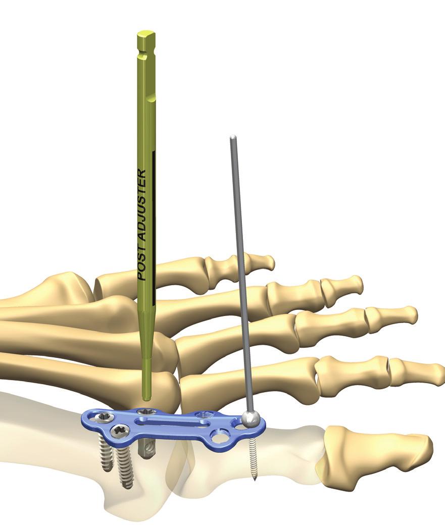 STEP 2 - PlantarFiX Compression Post Note: All instrumentation for the PlantarFiX Compression Post are colored gold.