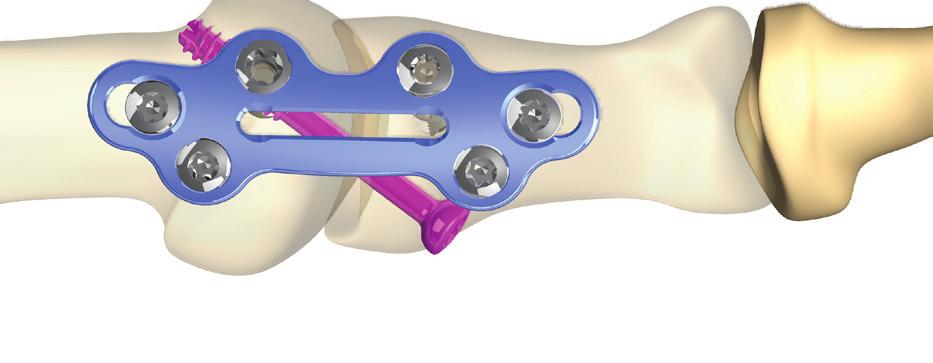 Step 5. Distal Fixation Insert the distal 2.8mm or 3.5mm Screws as desired.