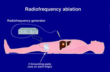 RFA Ablation of the Liver Tumours The Liver Radiofrequency Ablation (RFA) consists in the