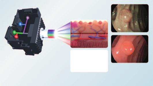 MULTI LIGHT TECHNOLOGY SEE MORE. DETECT MORE. Achieving optimal diagnostic and therapeutic results in endoscopic procedures is highly dependent on image quality.