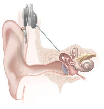 Cochlear implants (using a different computer to encode auditory