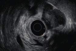 Color Doppler obtains hemodynamic information. It helps to locate an observation site and blood fl ow.